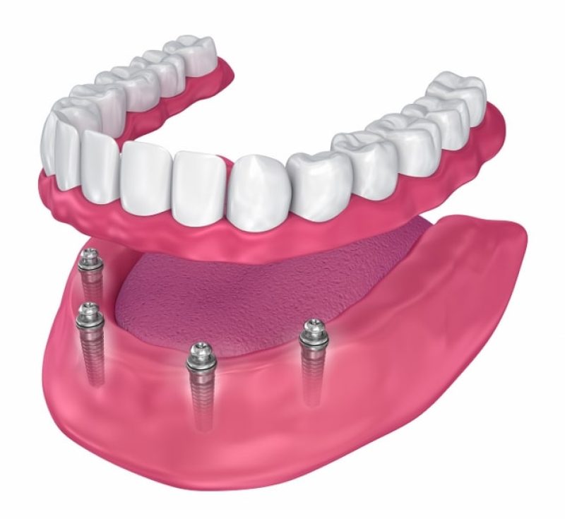 all-on-4-all-on-6-and-same-day-teeth all-on-4-all-on-6-and-same-day-teeth